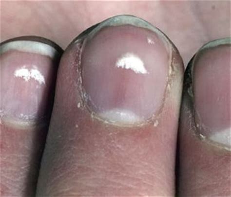leukonychia spots result from _____.|Leukonychia and Other Nail Discoloration: An Overview.